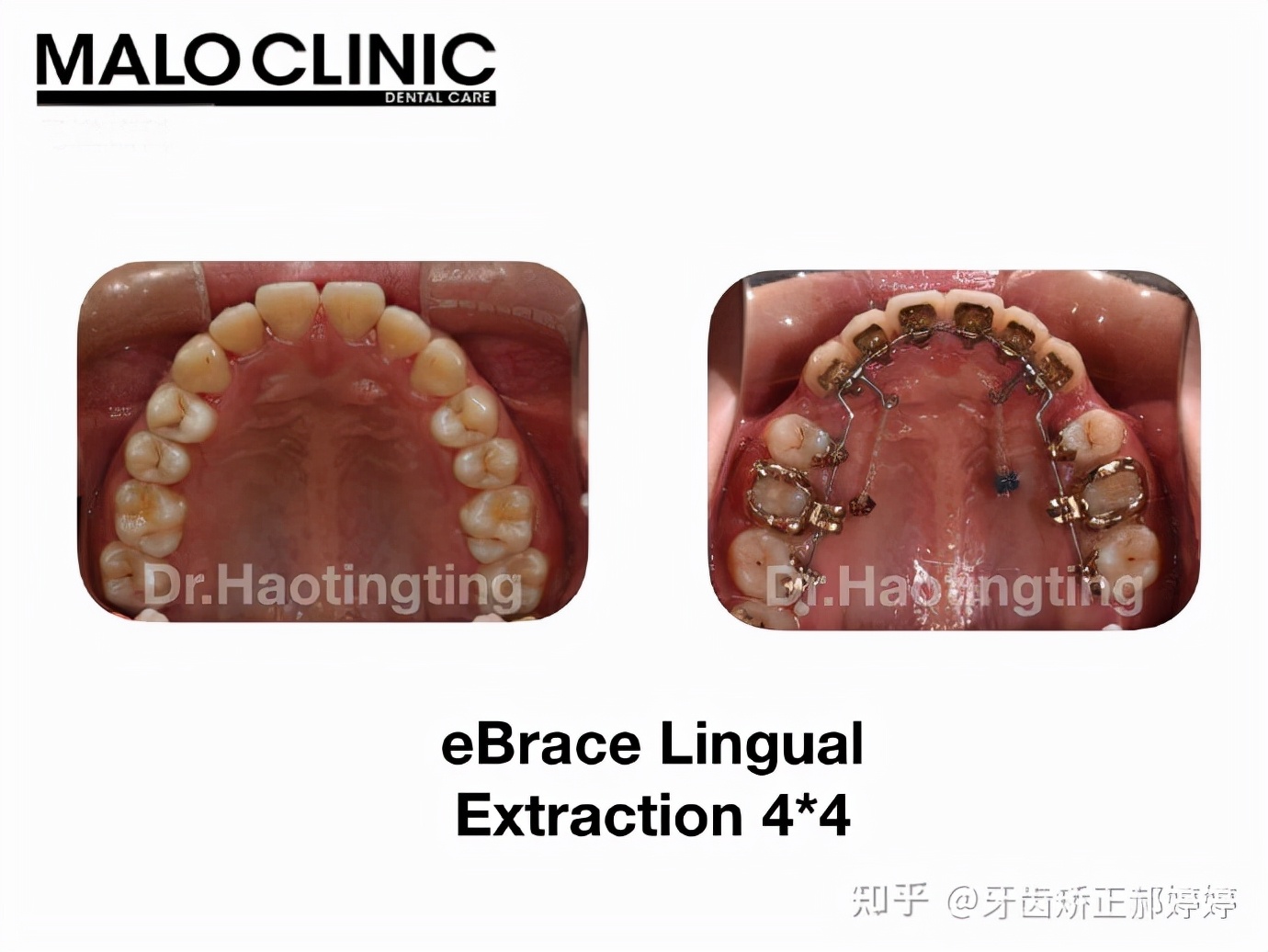 上海成人牙齿矫正失败案例,上海牙齿矫正郝婷婷医生