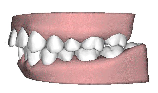 成年还可以做牙齿矫正吗,多大年纪就不能做牙齿矫正了呢