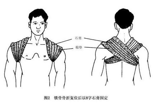 什么是脊椎病呢,颈椎病最严重的是哪种