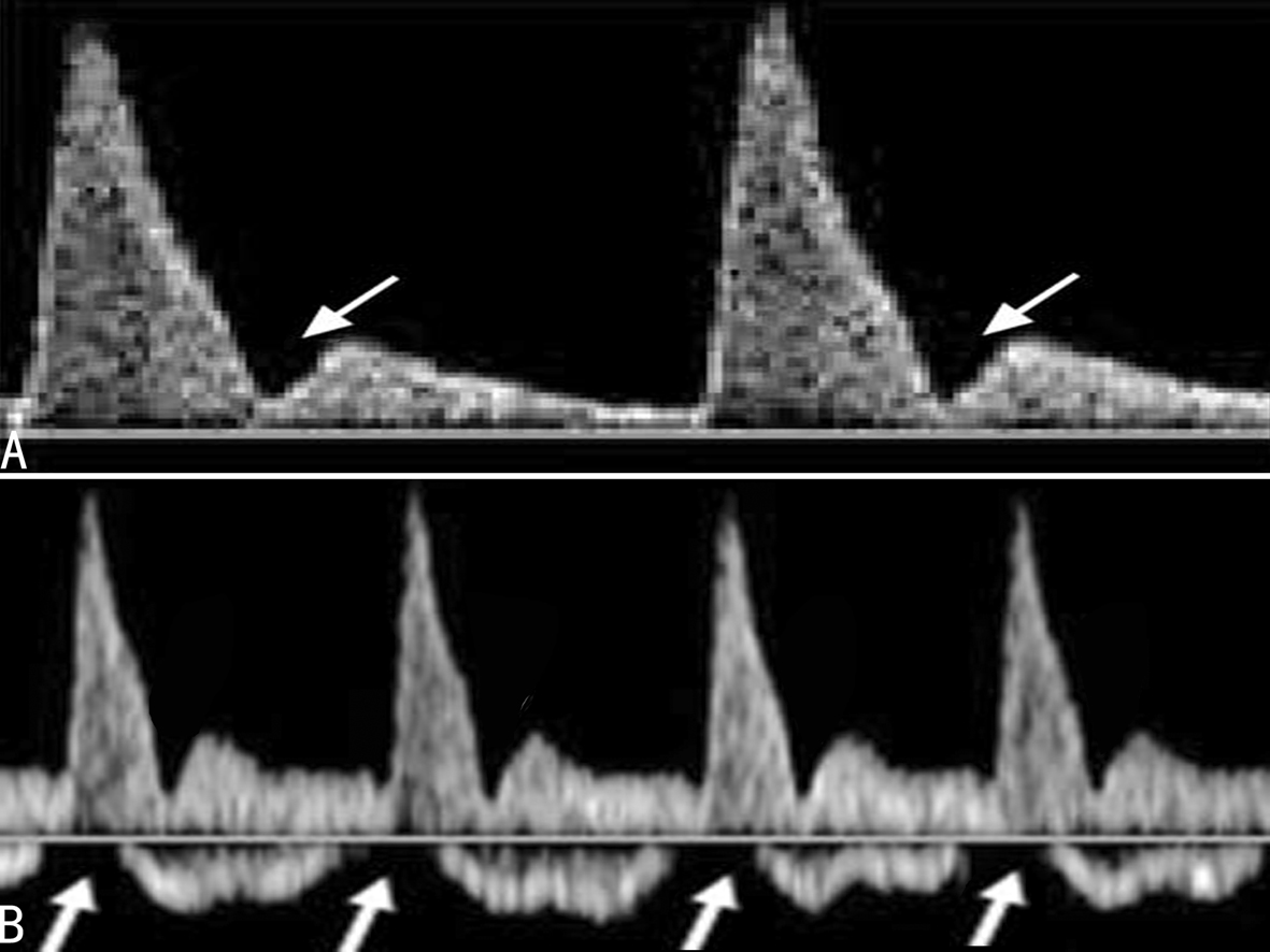 胎儿多普勒超声监测,胎儿多普勒超声检查对照表
