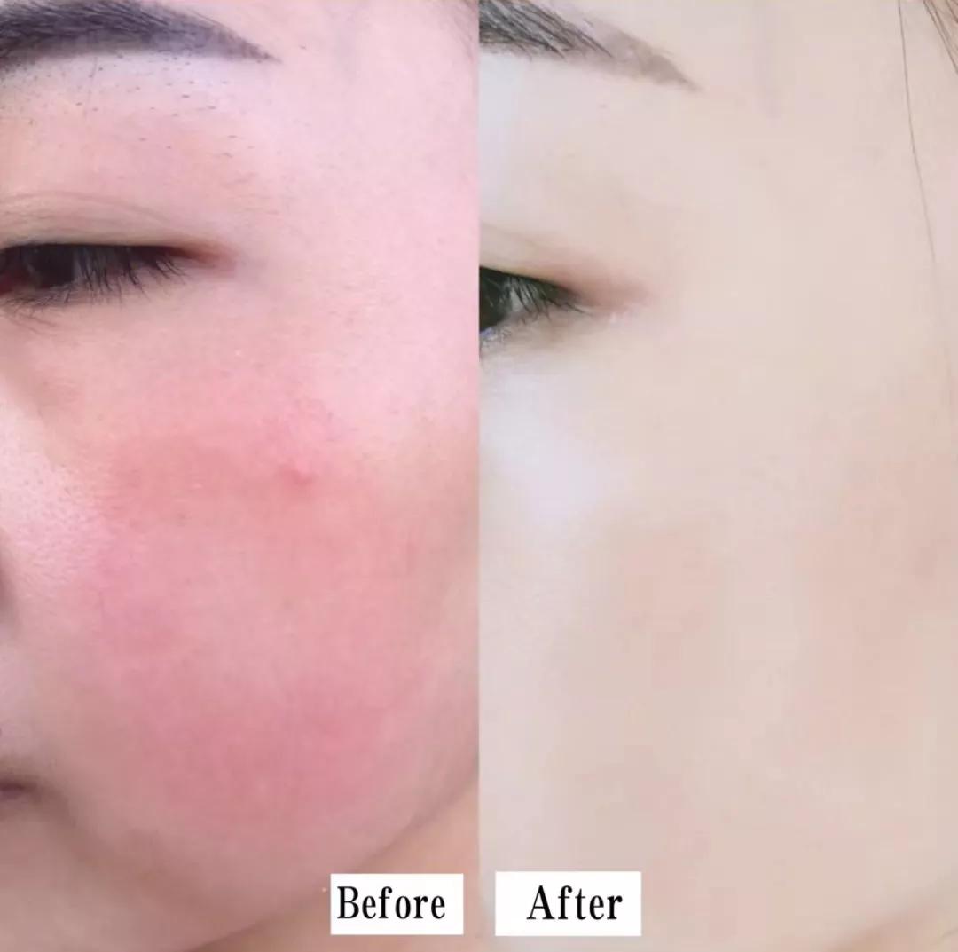 换季混油皮脸干到爆皮怎么办,干性皮肤脸出油护理