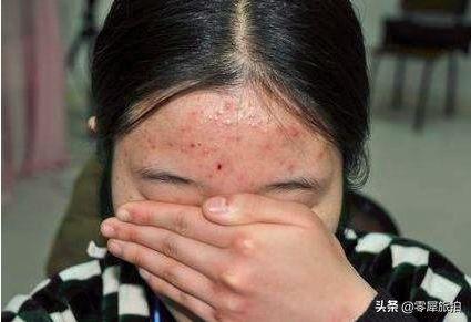 脸上长痘痘饮食注意什么,青春期脸上长痘痘饮食注意什么