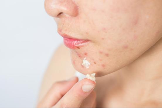 紫外线过敏皮炎擦什么软膏,夏天容易紫外线过敏是什么原因