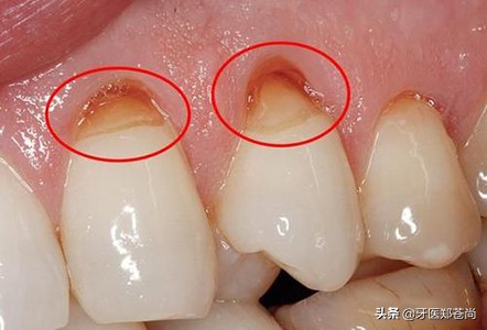 牙齿楔形磨损能修复吗,牙齿楔形损伤是什么意思