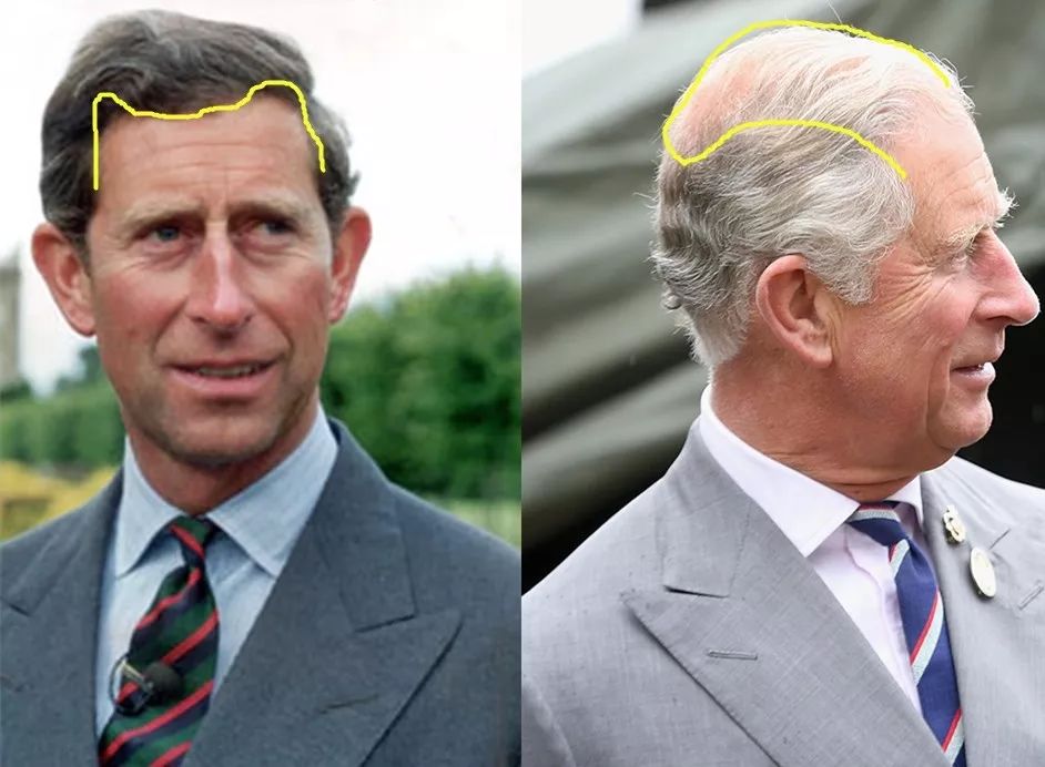 威廉王子秃顶了哈里为啥没秃顶,威廉王子为什么喜欢秃顶