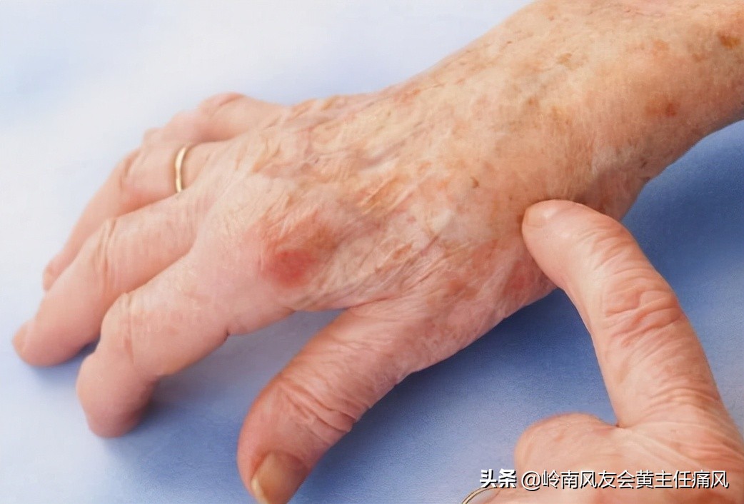 脚趾疼是痛风吗痛风都有什么症状,痛风是怎么引起的痛风有哪些症状