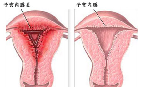 67岁得了子宫内膜癌,60多岁子宫内膜癌有死的吗