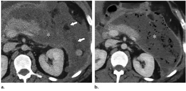 简述急性胰腺炎影像学表现,有关急性胰腺炎疼痛的图片
