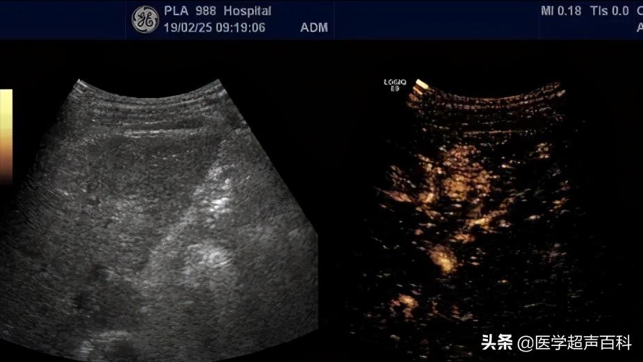 肝脏彩色超声检查报告单结果解释,肝脏超声检查报告单怎么看