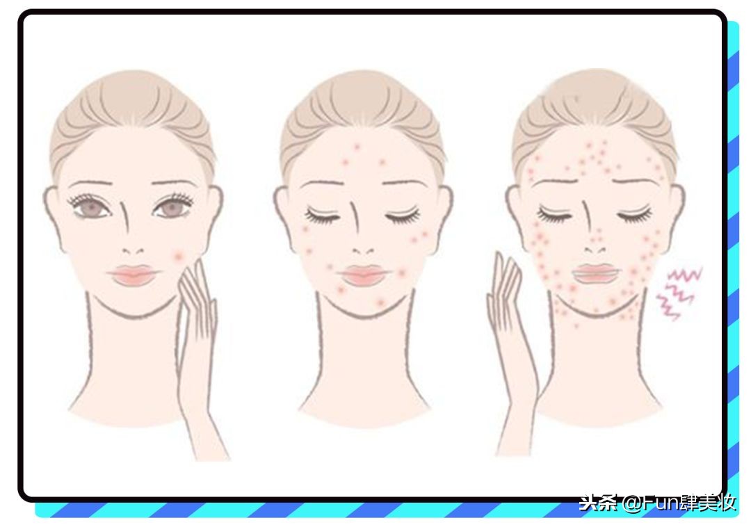 长痘怎么才能不留痘坑,痘肌自救方法视频