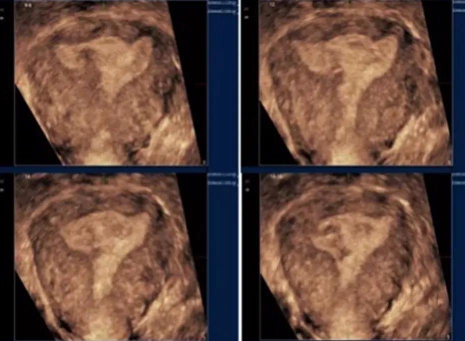 关爱女性|呵护子宫,不可忽视“宫腔粘连”