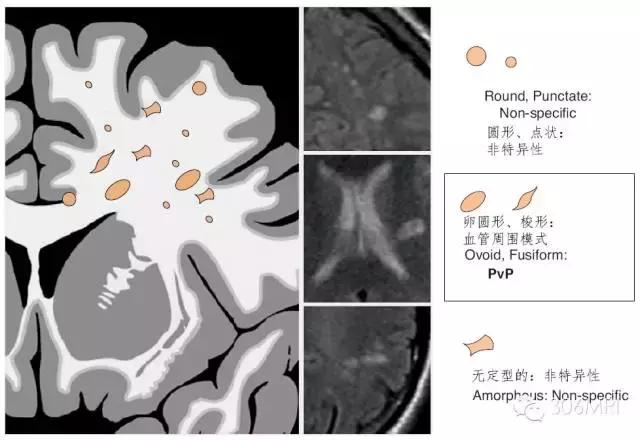大脑深部白质区见斑点状异常信号,脑白质病变建议mri检查是什么意思