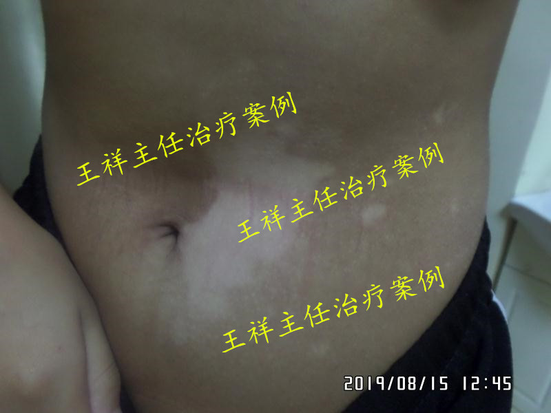 白癜风黑色素种植效果好吗,黑色素种植治疗白癜风费用