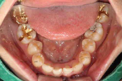 严重的蛀牙怎么修复,轻微的蛀牙修复全过程