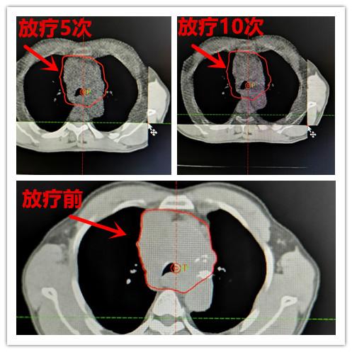 肿瘤患者化疗后体重增加了,肿瘤病人术后康复体重上升好吗
