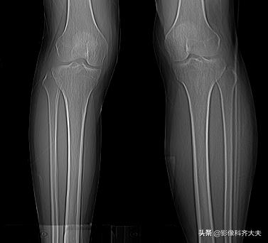 骨折的影像学检查及各自的优势,骨折的影像学愈合标准