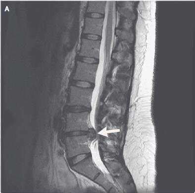 腰椎间盘突出针灸能治彻底吗,腰椎间盘突出针灸治疗能彻底吗