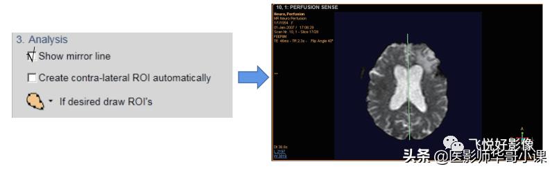 飞利浦磁共振脑灌注怎么测量,飞利浦核磁诊断教学