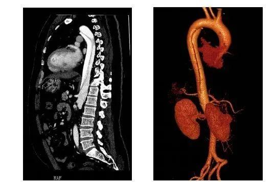 a型主动脉夹层,腹部主动脉夹层