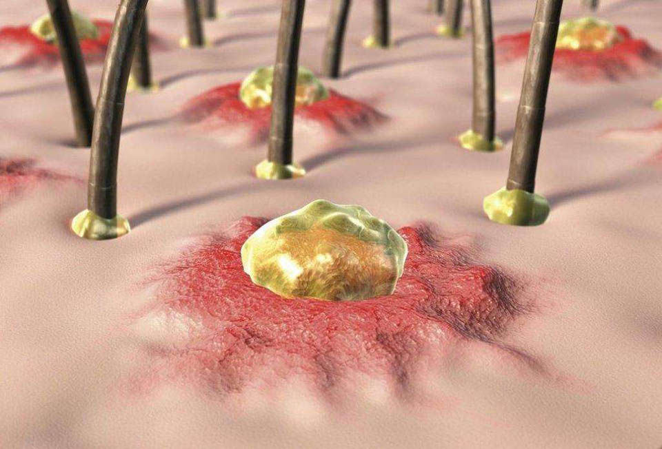 暗疮囊肿为什么要消炎,起脓疮型痘痘用什么药