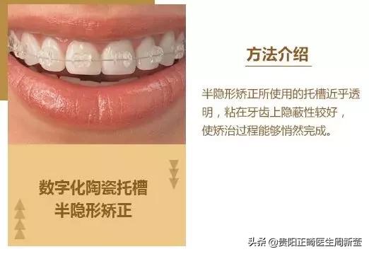 变美干货分享轻医美,矫正牙齿小干货