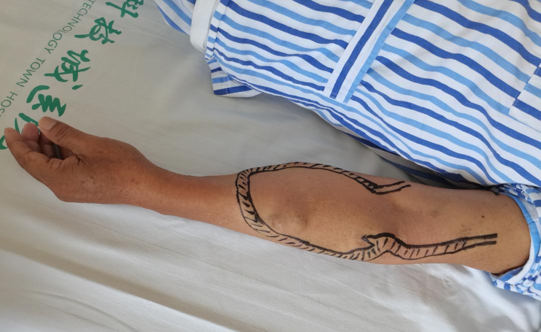 血透内瘘球囊扩张术痛吗,血透导管堵塞如何溶栓