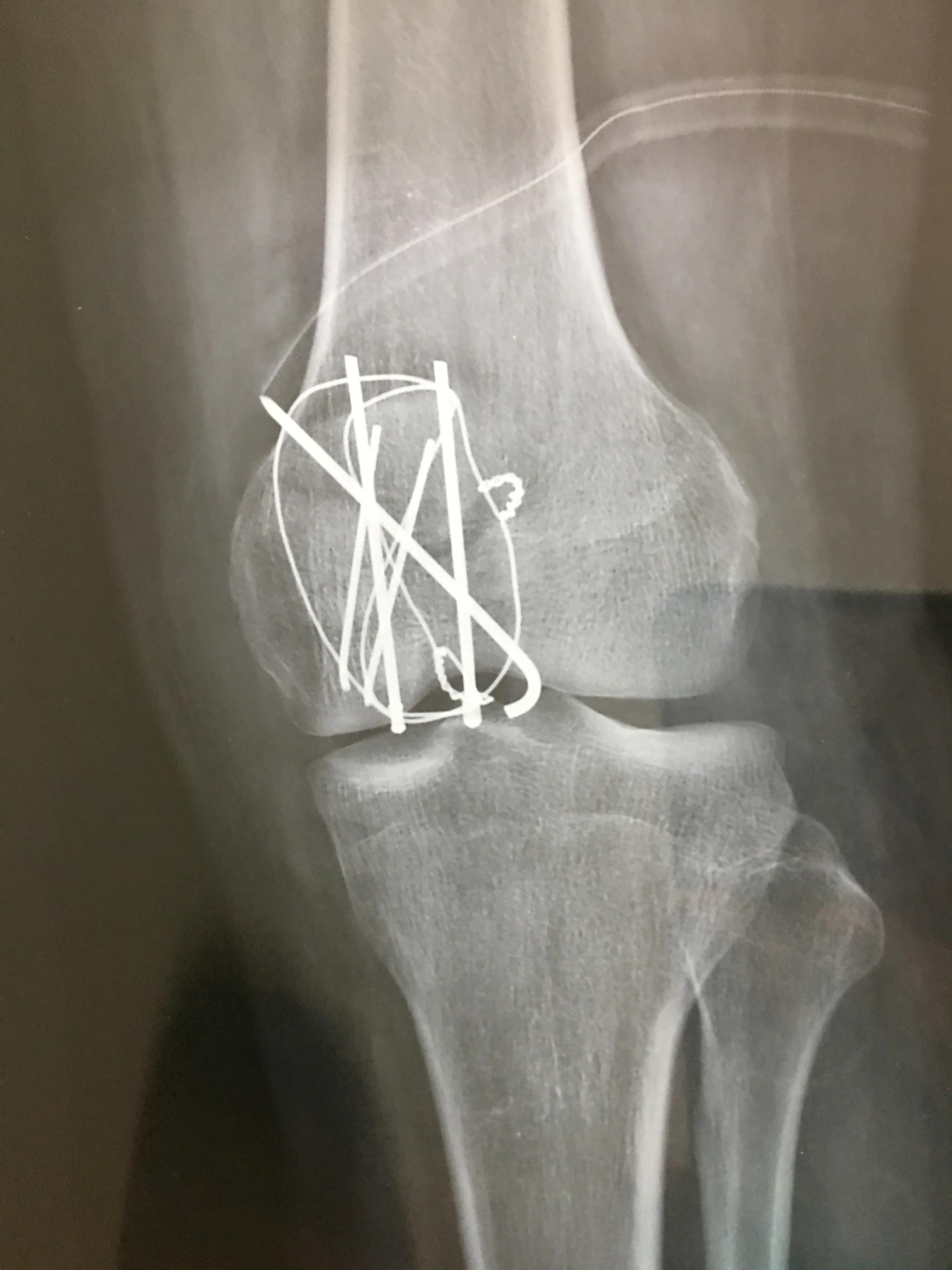 髌骨骨折取内固定费用多少,髌骨骨折保守治疗后的康复训练