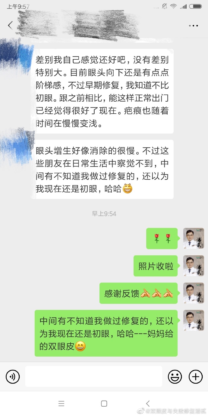 广州双眼皮凹陷修复视频,小切口双眼皮肉条修复