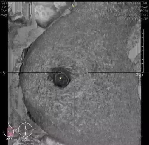 乳房肿块和纤维腺瘤,乳腺纤维腺瘤肿块有无血流信号