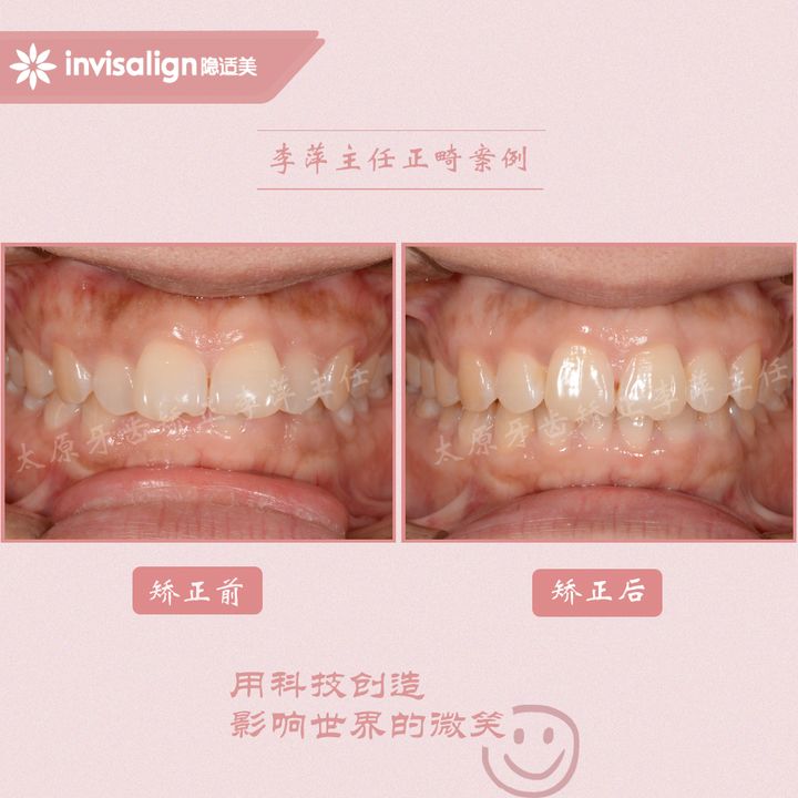 太原矫正牙齿需要做正颌吗,太原牙齿二次矫正