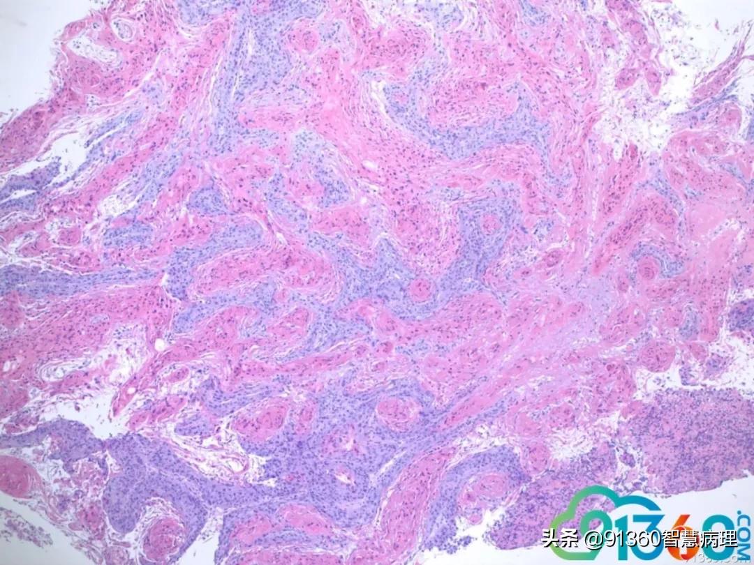 宫颈病理检查与tct检查的区别,病理诊断宫颈活检鳞癌