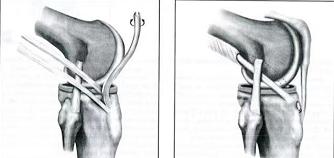 膝关节前叉韧带损伤最佳恢复方法,膝关节前韧带断了必须手术吗