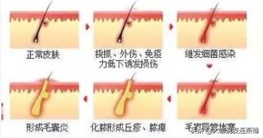 植发后毛囊炎怎么彻底根治,植发后出现毛囊炎吃什么中成药
