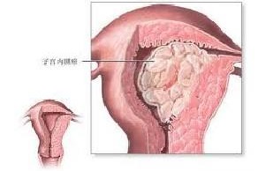 怎么会引起内膜增厚,颈动脉分叉处内膜增厚