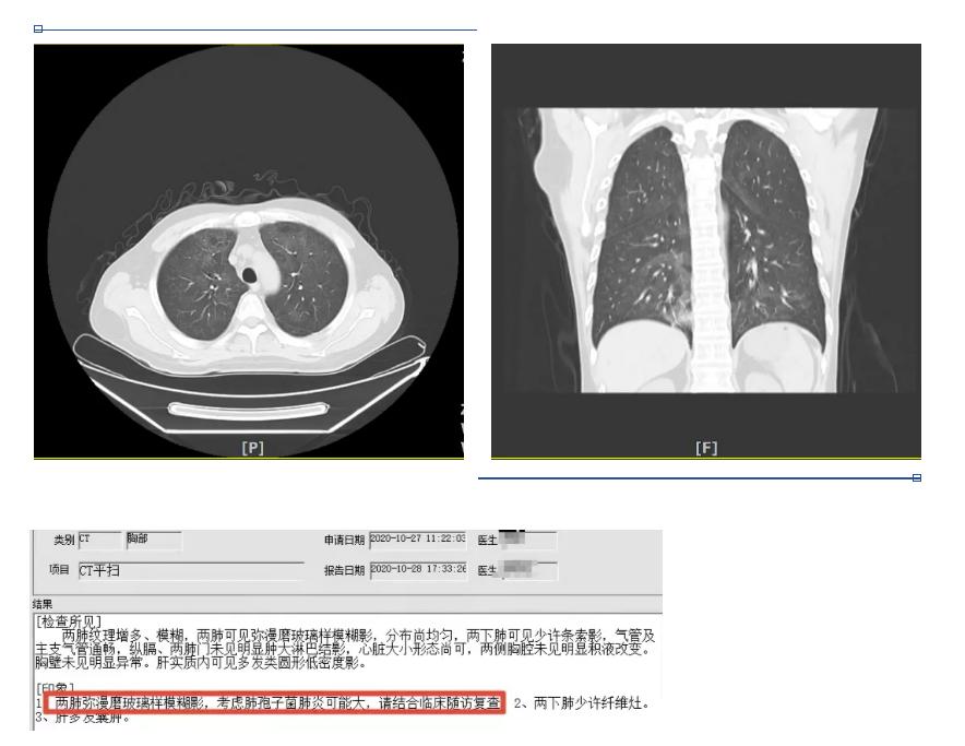 肺泡灌洗液细胞学检查“只需”看细胞吗？（续）