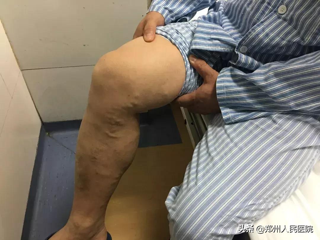 蚯蚓腿需要治疗吗,蚯蚓腿不开刀治疗