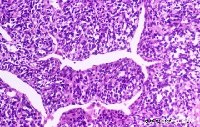 肺肿瘤标志物怎么检查,常用肿瘤标志物筛查