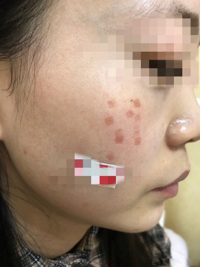 点阵激光能修复到什么程度,点阵激光凹陷疤痕能修复多少