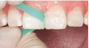 门牙裂了一条缝,门牙有缝的女人