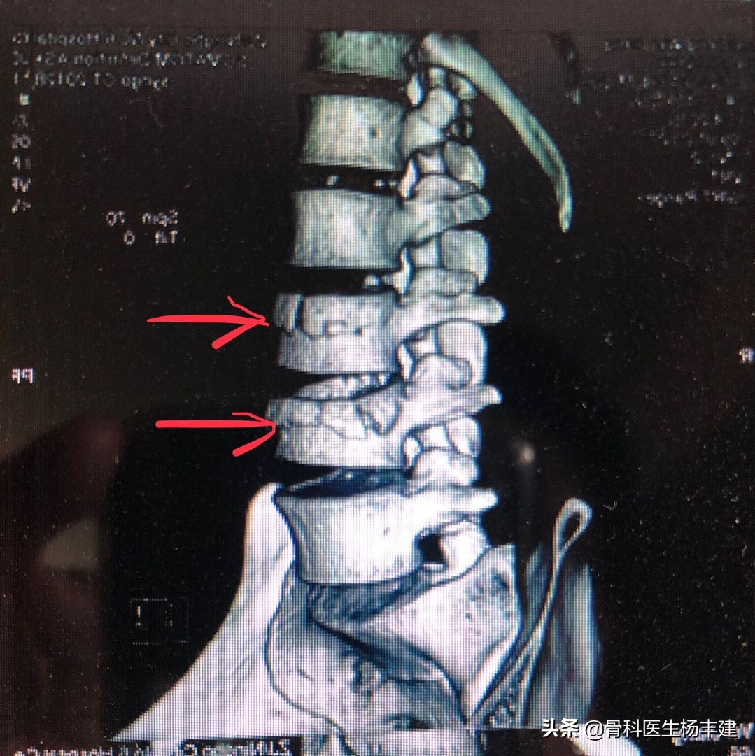 专家建议：老年人出现腰椎骨折，不一定需要做手术！