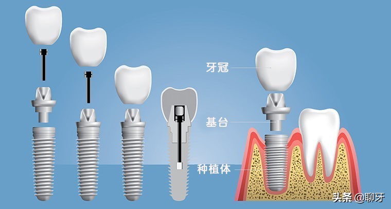 种植牙是什么种植技术,种植牙一般要怎么种植的