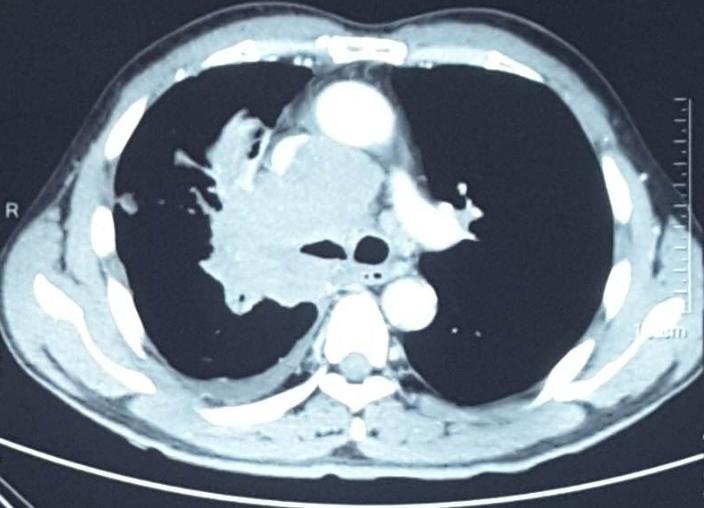 肺癌咯血的原因及治疗方法