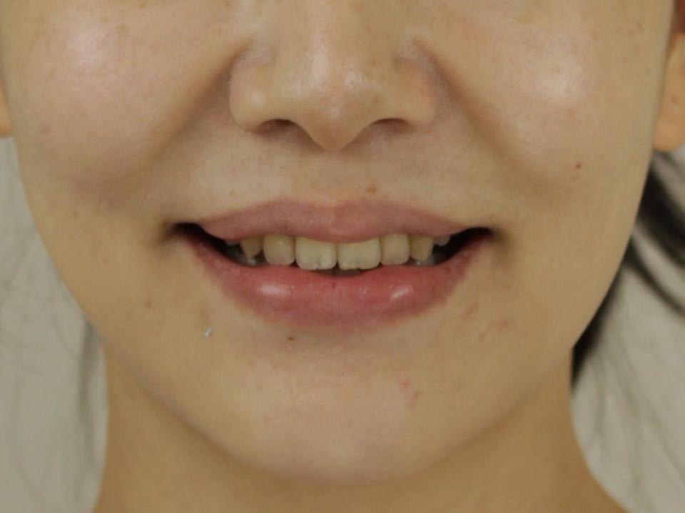 西安张军正畸医生如何,西安牙齿矫正案例