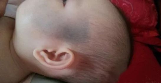 宝宝身上有不光滑胎记,宝宝身上胎记不哭就没有
