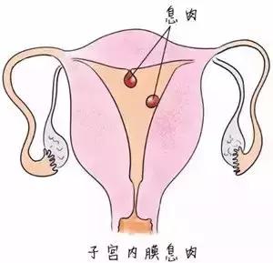 子宫息肉不孕,不孕的头号杀手
