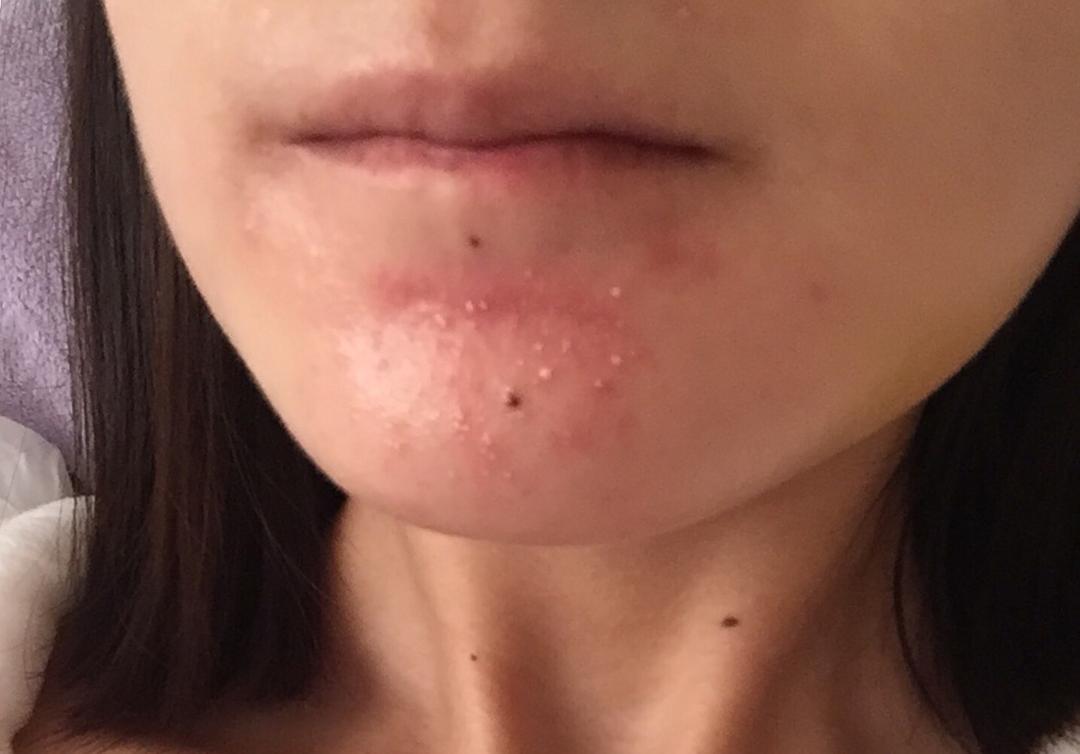 下巴突然长了一大片闭口粉刺,下巴光长粉刺疙瘩是什么原因
