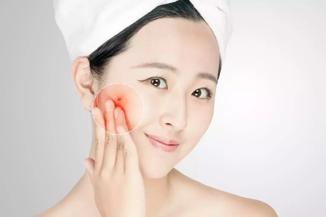 激素脸怎么形成的原因,激素脸有什么特征