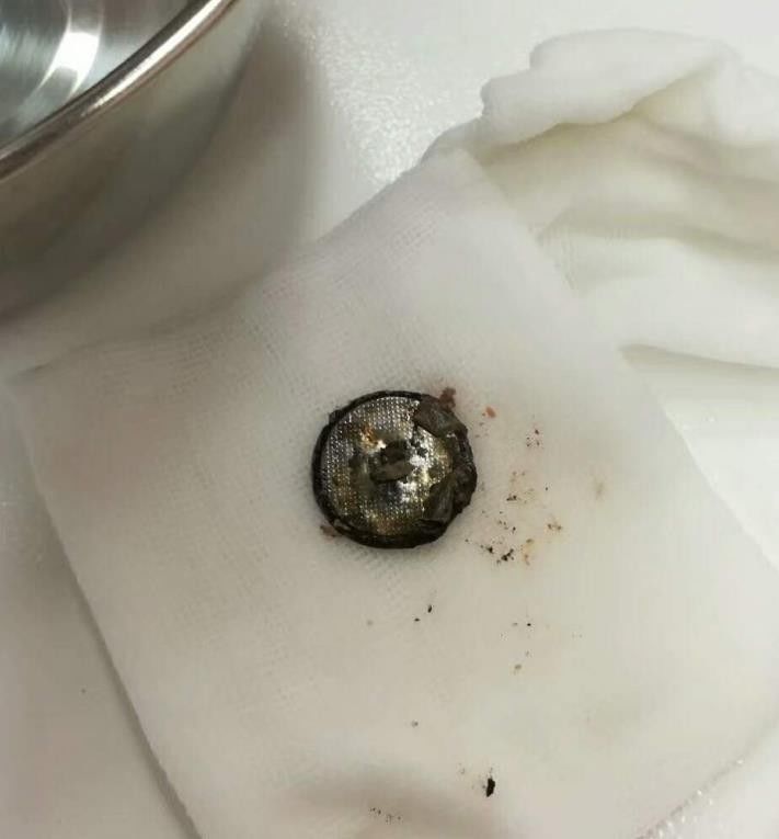 小孩吃电池腐蚀食道后果,7岁小朋友误吞异物怎么处理