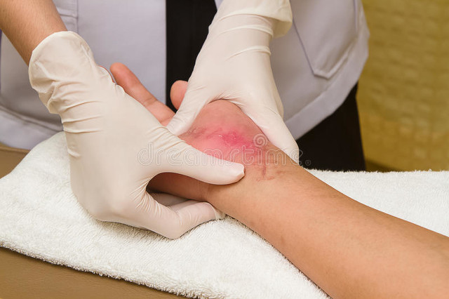 全切双眼皮疤痕增生多久可以变平,凸起增生疤痕怎么变平