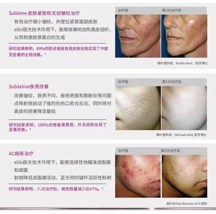 elōsPlus光电传奇，集祛斑除皱紧肤提升于一体